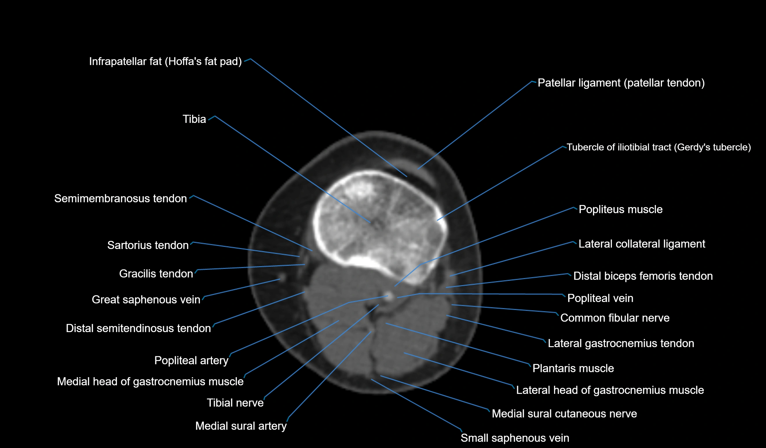 CT knee axial cross sectional anatomy labelled image-00041.webp
